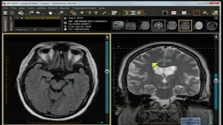 Neuro Imaging: Board and Recredentialing Review 2