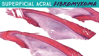 Superficial Acral Fibromyxoma (Digital Fibromyxoma) - Benign Finger Tumor (Yale case 4)