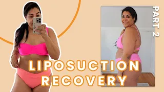 Carlene's Journey: Recovering from Laser Lipo surgery and One Week Fat Loss Results