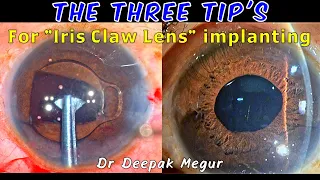 The 3 tips for Iris Claw Lens Implantation - Dr Deepak Megur