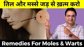 तिल और मस्से बिना लेज़र या सर्जरी जड़ से ख़त्म करें | तिल और मस्से का इलाज | Moles & Warts Treatment