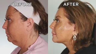 Watch Abby Lee Miller Get a Facelift While Awake!