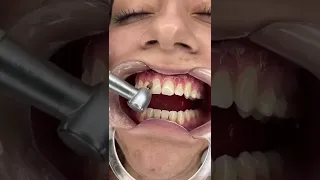 Removing Braces