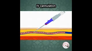 💉 INTRAVENOUS (IV) CANNULATION ANIMATION