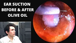 Ear Wax Suction BEFORE and AFTER Olive Oil (3 day gap)