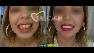 facettes dentaires veneers tunisie