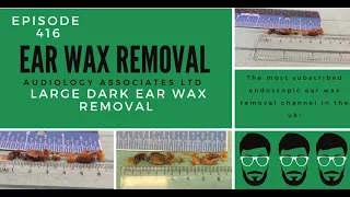 LARGE DARK EAR WAX PLUG REMOVAL - EP 416