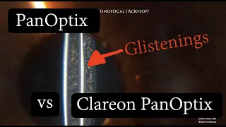 PANOPTIX vs CLAREON PANOPTIX.  Difference in Glistenings?