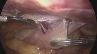 Лапароскопическая TME, опухоль на 10 см / Laparoscopic TME, femail, tumor for 10 cm