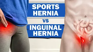 Sports Hernia Vs Inguinal Hernia - Symptoms And The Differences?