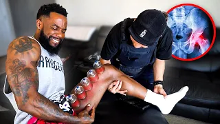 Extremely Painful! Cupping Therapy For Pulled Groin Muscle Relief!