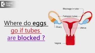 Where does the egg go if fallopian tubes are blocked? - Dr. Mangala Devi KR