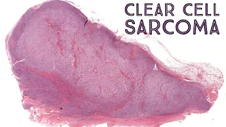 Clear cell sarcoma - very rare mimic of metastatic melanoma (AIP France 2021 - Case 11)