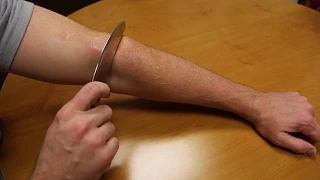 IASTM For Tennis Elbow Using Myofascial Tools-Glider Tool