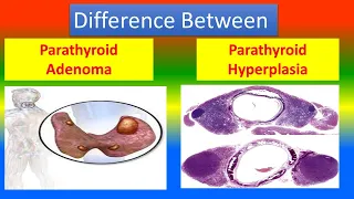 Difference Between  Parathyroid Adenoma and  Parathyroid Hyperplasia