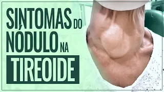 NÓDULO NA TIREOIDE - Quem tem, sente o quê?