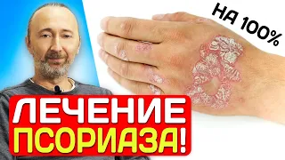 Псориаз, экзему лечите ТАК: Раз и навсегда!