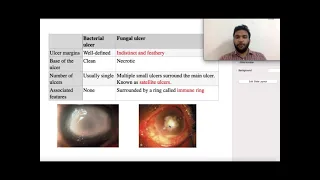 ophthalmology Bacterial keratitis concept for neetpg, Inicet, Fmge, Next mbbs