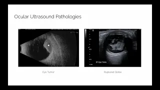 Ocular Ultrasound - Ultrasound in Ophthalmology