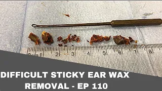 DIFFICULT STICKY EAR WAX REMOVAL - EP 110
