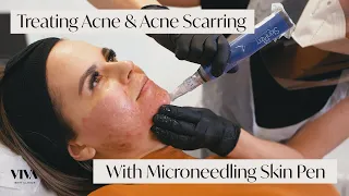 This Is Microneedling for Acne Scarring 🎯