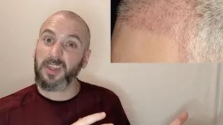 FUE Hair Transplant Recovery - Week 4