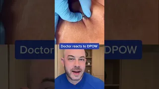 Doctor reacts to massive DPOW extraction! #dermreacts #doctorreacts #dpow