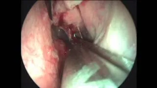 Isolated sphenoidal sinusitis - Mini FESS (Sphenoidotomy).