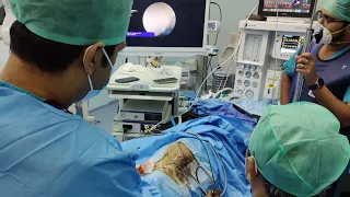 Supine Mini PCNL for staghorn calculus in a two year old boy at AINU Chennai @Pediatric-Urologist