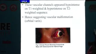 AIOC2019 Hyde Park III FP483 Orbital Venous Varix–An Uncommon Vascular Malformation Dr Parag Ramnani