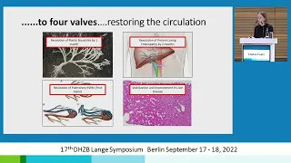 22 Physiological adaptation after TX in single ventricle   From one to four valves Coats