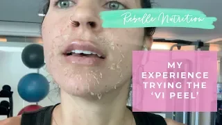 MY EXPERIENCE  - Vi Peel For Hyperpigmentation/ Melasma