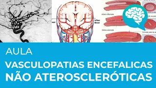 VASCULOPATIAS ENCEFÁLICAS NÃO ATEROSCLERÓTICAS | AULA