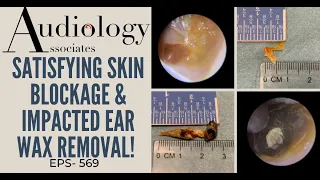 SATISFYING SKIN BLOCKAGE & IMPACTED EAR WAX REMOVAL - EP569