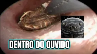 CARRAPATO Estranho Dentro do Ouvido de Uma Pessoa