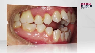 Orthodontic Challenging Case: Open Bite