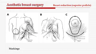 Aesthetic breast surgery   superior pedicle.  Ahmed Ali Hassan, MD