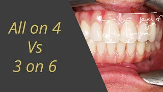 All-on-4 vs 3-on-6 Whats Better For a Full Set of Teeth on Dental Implants