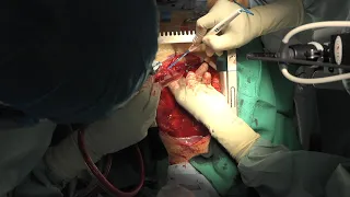 Aortic dissection /Total arch replacement and Frozen elephant trunk /ope  time200min