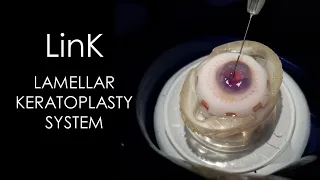 BIONIKO LinK IFU - LAMELLAR KERATOPLASTY SYSTEM