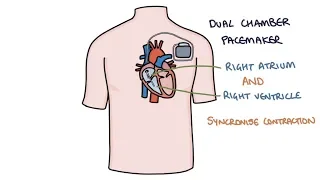 Understanding Pacemakers