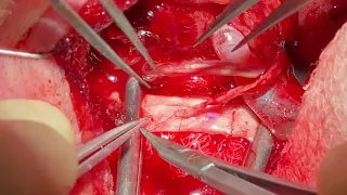 microsurgery-venous anastomosis