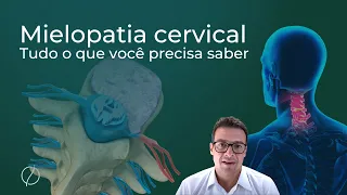 Mielopatia cervical: Tudo o que você precisa saber, sintomas e cirurgia.