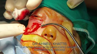 SUBPERIOSTEAL ABSCESS - COMPLICATED SINUSITIS