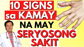 10 Signs sa Kamay na May Seryosong Sakit - Payo ni Doc Willie Ong