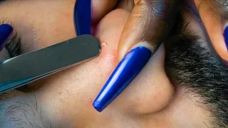 {ASMR} Nurse Nitpicking & EXTRACTING Face WHITEHEADS & INGROWNS | Eyebrow Scratching | ALLZOOMED