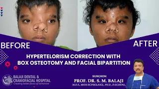 Hypertelorism Correction with Box Osteotomy and Facial Bipartition
