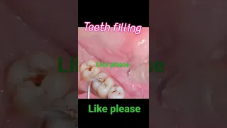 teeth filling 🥧🍰🥧🍰 teeth cavity #video