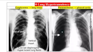 شرح أشعة الصدر Chest x-Rays د. محمود سويلم