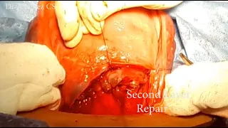 Dr. A.Hafez Caesarean Section Operation